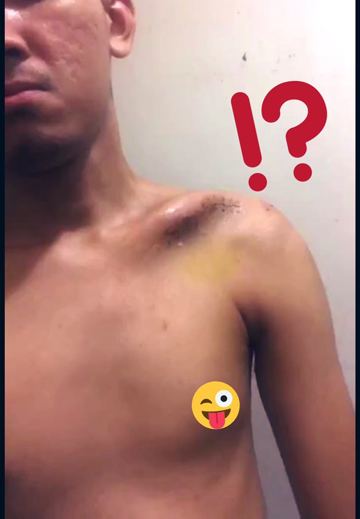 fiquecool's tweet image. 1st Pic (L)- 1st OP -03/5/19 
2nd Pic (R) - 2nd OP-10/06/19
 Hope makin cepat sembuh n cepat-cepat pulih! No more kali-3 pliz!  🤒🥺😩

#PostOperation
#BesiBaru
#ComeBackStronger
#LepasDiscaj4MingguLepas 
#MyClavicle 😭 
#PrayForPedro