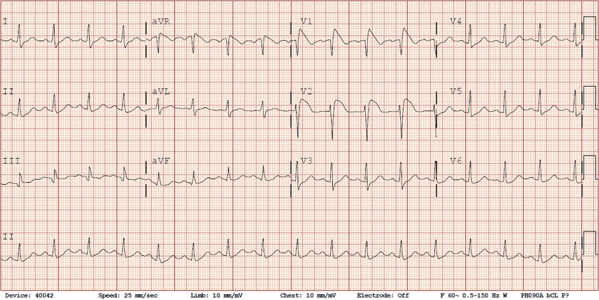 A 50 y/o woman w/ HTN, HLD & no prior CV disease, presents w/ fever & abdominal pain. Prior to OR suffers VF arrest requiring cardioversion. 

ECG is obtained – what next? Vote below & learn more from this excellent case in the inaugural #JACCCaseReports. fal.cn/32Kwq