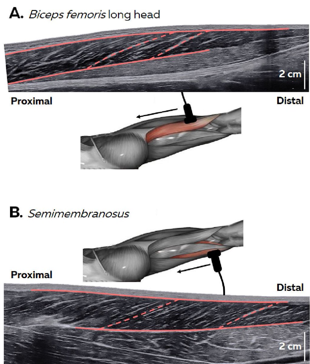 mart1buch's tweet image. The quadrant of doom &amp;amp; hamstring injuries: sexy 👙 but too easy ✌️?
📃 bit.ly/325KeZN
🤔Impact of body mass and muscle size on Nordbord perf?
🤔Single muscle scan vs. whole hamstring group?
🤔Passive scan vs. active movements?
🤔2D: effect of age and previous injuries?