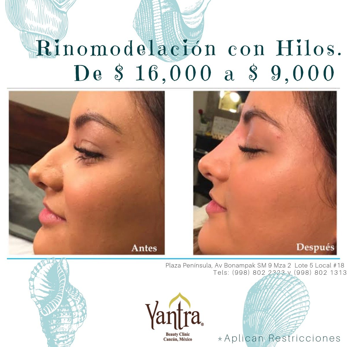 Luce un cuerpo de VERANO
APROVECHA esta promoción de #JULIO Rinomodelación con Hilos.
De $16,00 a $9,000
AGENDA CON NOSOTROS #Julio mes de #PielDeVerano
Agenda tu cita al 802 2323
📍 Estamos en Av. Bonampak, Plaza Península de lunes a viernes de 9AM a 9PM y sábados de 9AM a 3PM