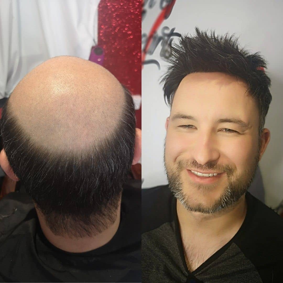 QueenofHeartsNE's tweet photo. #Men's before and after hairloss system.  #mensbeforeandafterhairlosssystem #malebaldness #menshair #hairloss #toupee #barber #Sunderland #hairextensions #wig https://t.co/NvDW00gdgV
