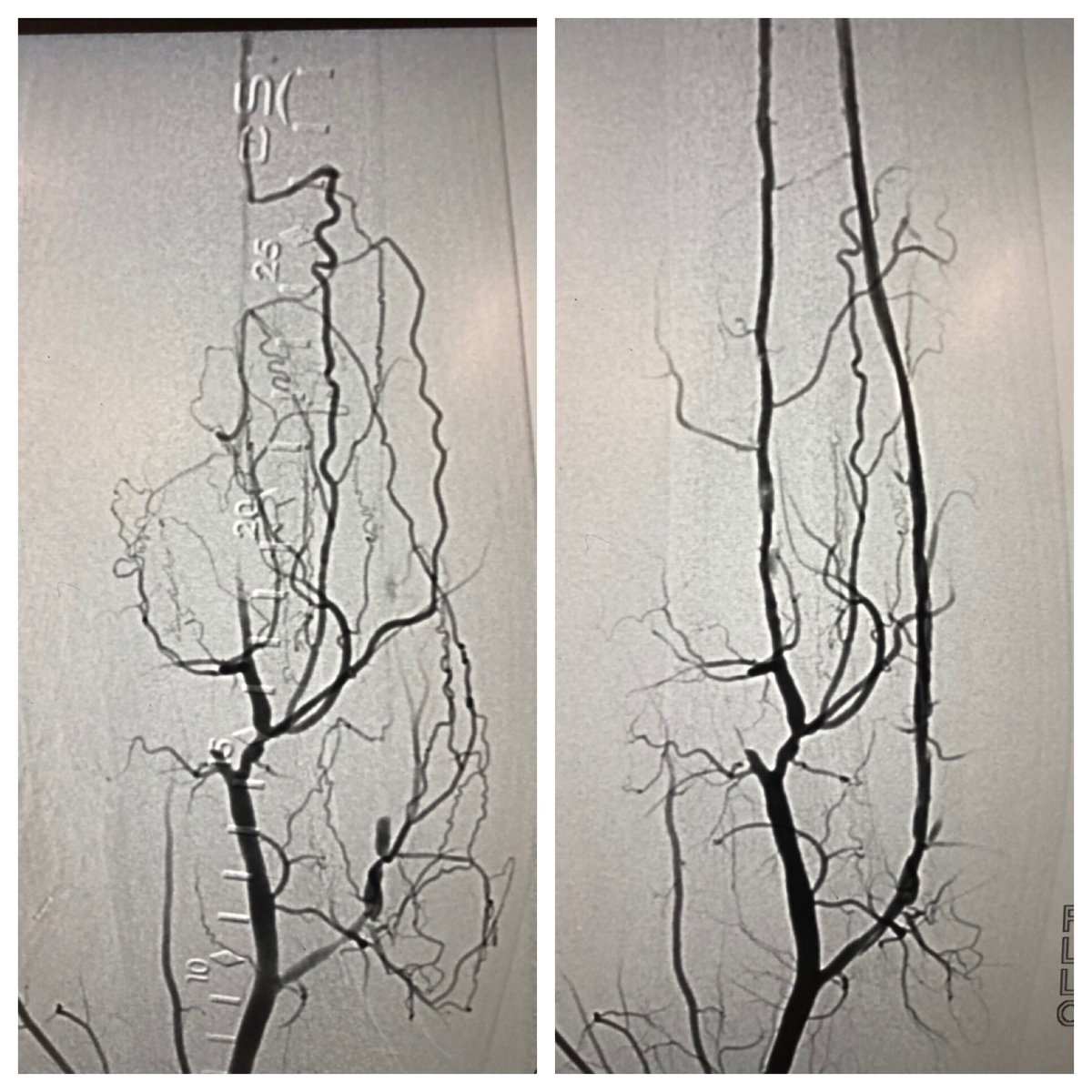 matheenkhuddus's tweet image. Late case before time off for the 4th! Open toe wound w/ osteo. Antegrade crossing of occluded peroneal. Tibial access to cross long segment ATA occlusion after failed antegrade attempt. Initial access too close to distal cap so moved distal #CLI #SCAIPAD #wifeissounderstanding