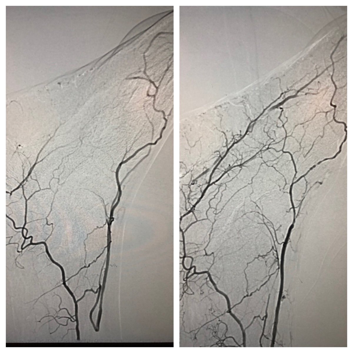 matheenkhuddus's tweet image. Late case before time off for the 4th! Open toe wound w/ osteo. Antegrade crossing of occluded peroneal. Tibial access to cross long segment ATA occlusion after failed antegrade attempt. Initial access too close to distal cap so moved distal #CLI #SCAIPAD #wifeissounderstanding