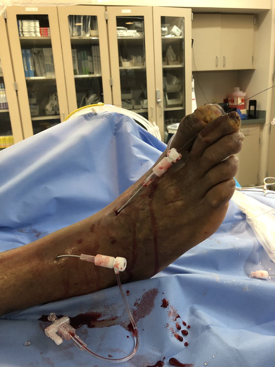 matheenkhuddus's tweet image. Late case before time off for the 4th! Open toe wound w/ osteo. Antegrade crossing of occluded peroneal. Tibial access to cross long segment ATA occlusion after failed antegrade attempt. Initial access too close to distal cap so moved distal #CLI #SCAIPAD #wifeissounderstanding