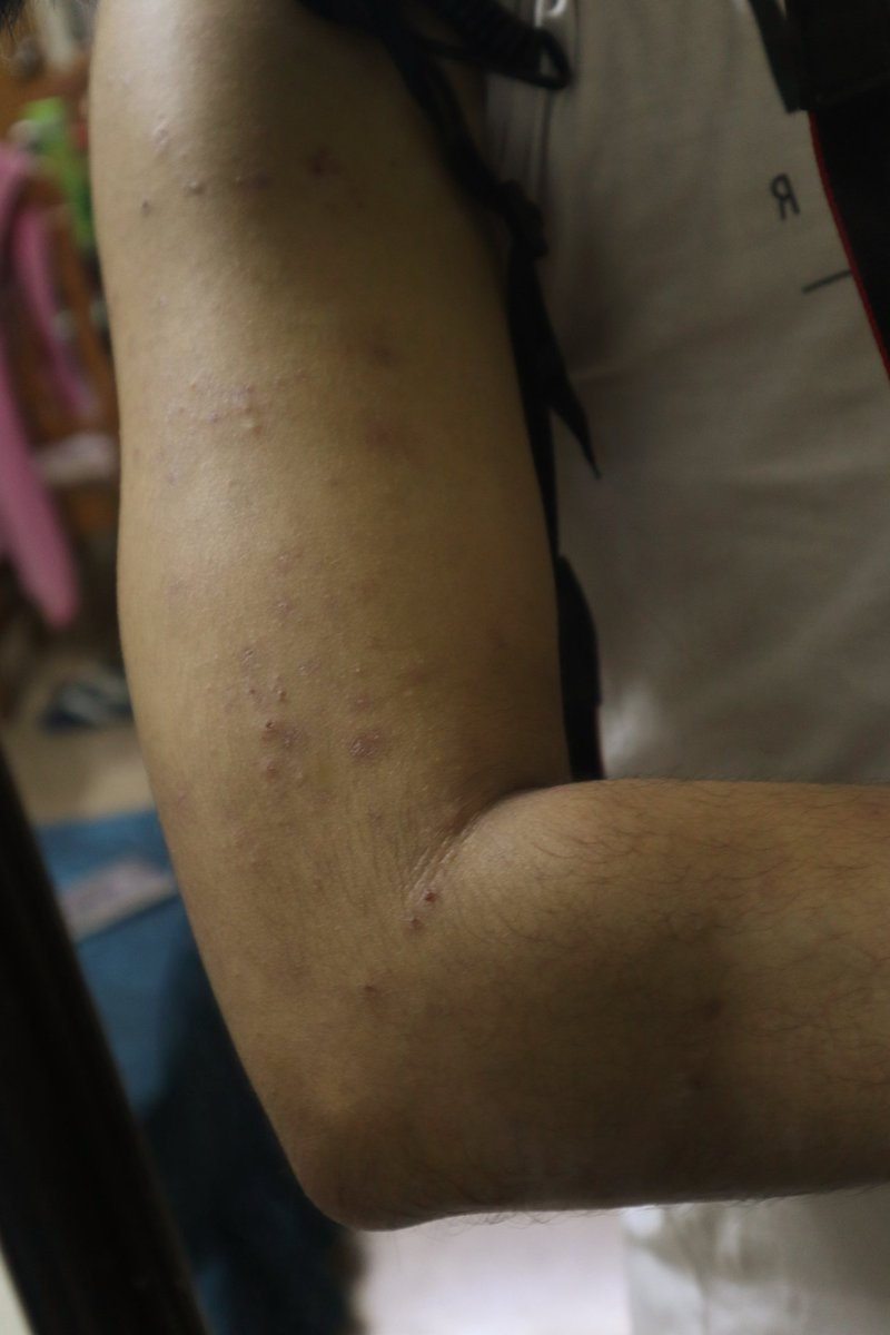 RoyalBld1995's tweet photo. So Im using MMS again since I stopped it and looked what happened ugh. I need to get back on treatment kainis dumami tuloy sia hays. https://t.co/3j9ca3CWqP