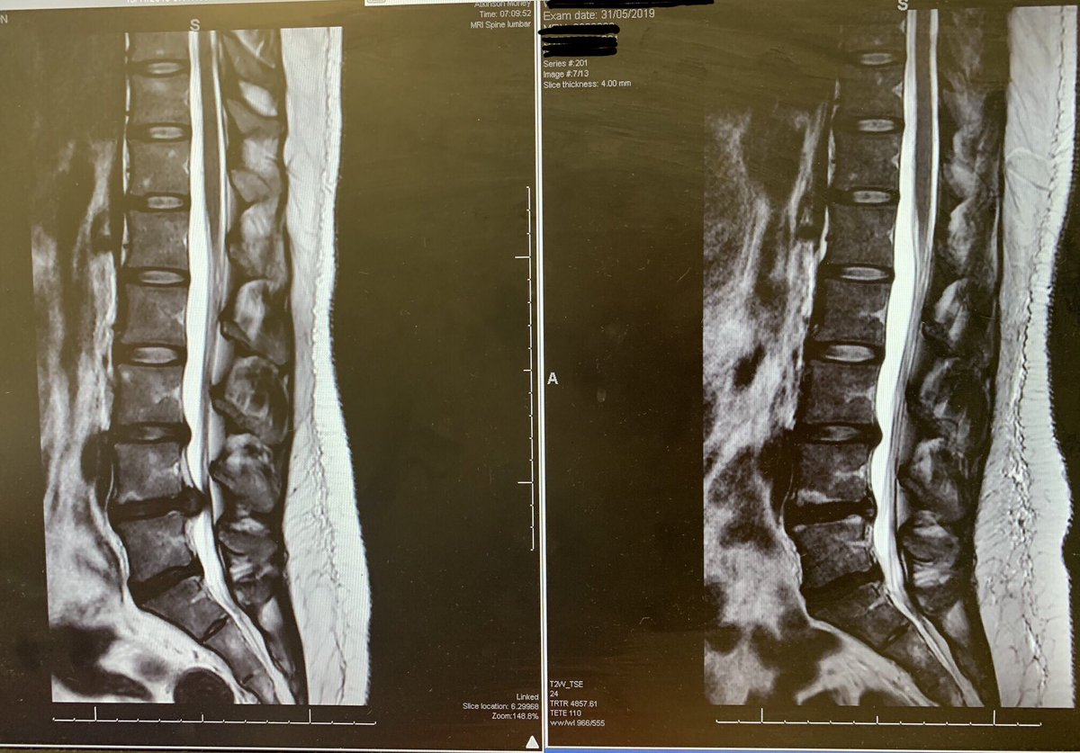 BoardDan's tweet image. 28yo friend with severe back and leg pain. MRI Nov18(L) shows “Large L4/5disc protrusion w severe cord narrowing/ crowding of cauda equina rootlets” ...MRI May19(R) 7 months later shows reabsoprtion and now pain free! Great example of conservative Mx &amp;amp; ‘watch &amp;amp; wait’ approach 🙌