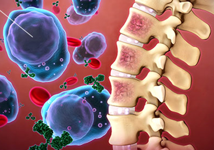 Miyelom Tedavisinde Yeni Gelişme 
#hematolojiistanbul #memorialataşehirhematoloji #miyelom #miyelomtedavisi #miyelomdayenitedavi #multiplemyelom #myeloma #profdrhisari #selinexor profdrhisari.com/miyelom-tedavi…