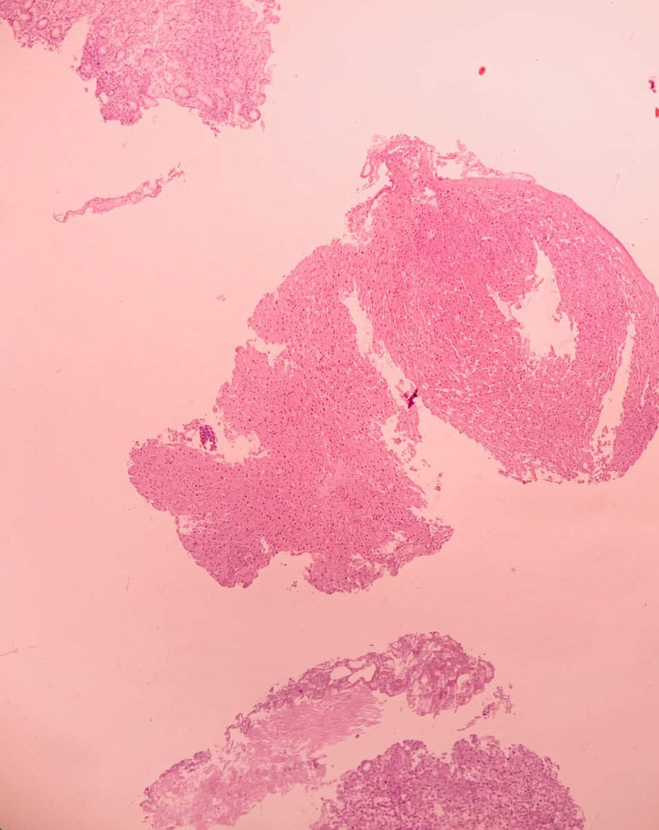 DrAhmedKalebi's tweet photo. Great case showed to me by my colleague Dr Prem Gupta at Lancet Laboratories Tanzania in Dar es Salaam. Gastric endoscopic biopsy. Microscopy shows gastric mucosal fragments and tumor. Diagnosis / DDx? #GIPath #Pathology (photo taken with iPhone๐ฑ) https://t.co/5z9jJ62BiL