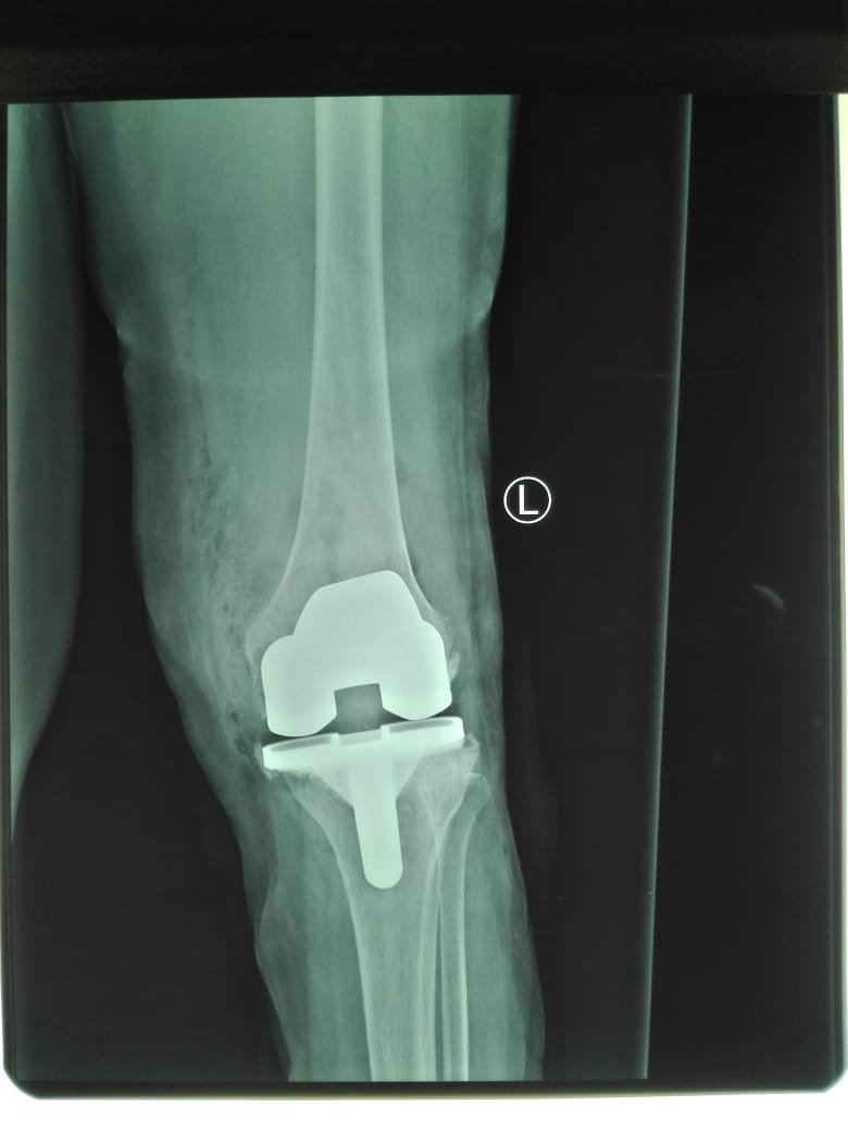 The first total knee replacement has been done in the New Makindu Hospital Trauma Centre, Makueni County.

The operation entails removing the arthritic articulating surfaces of the Distal Femur and  Proximal Tibia and replacing them with a knee prosthesis.