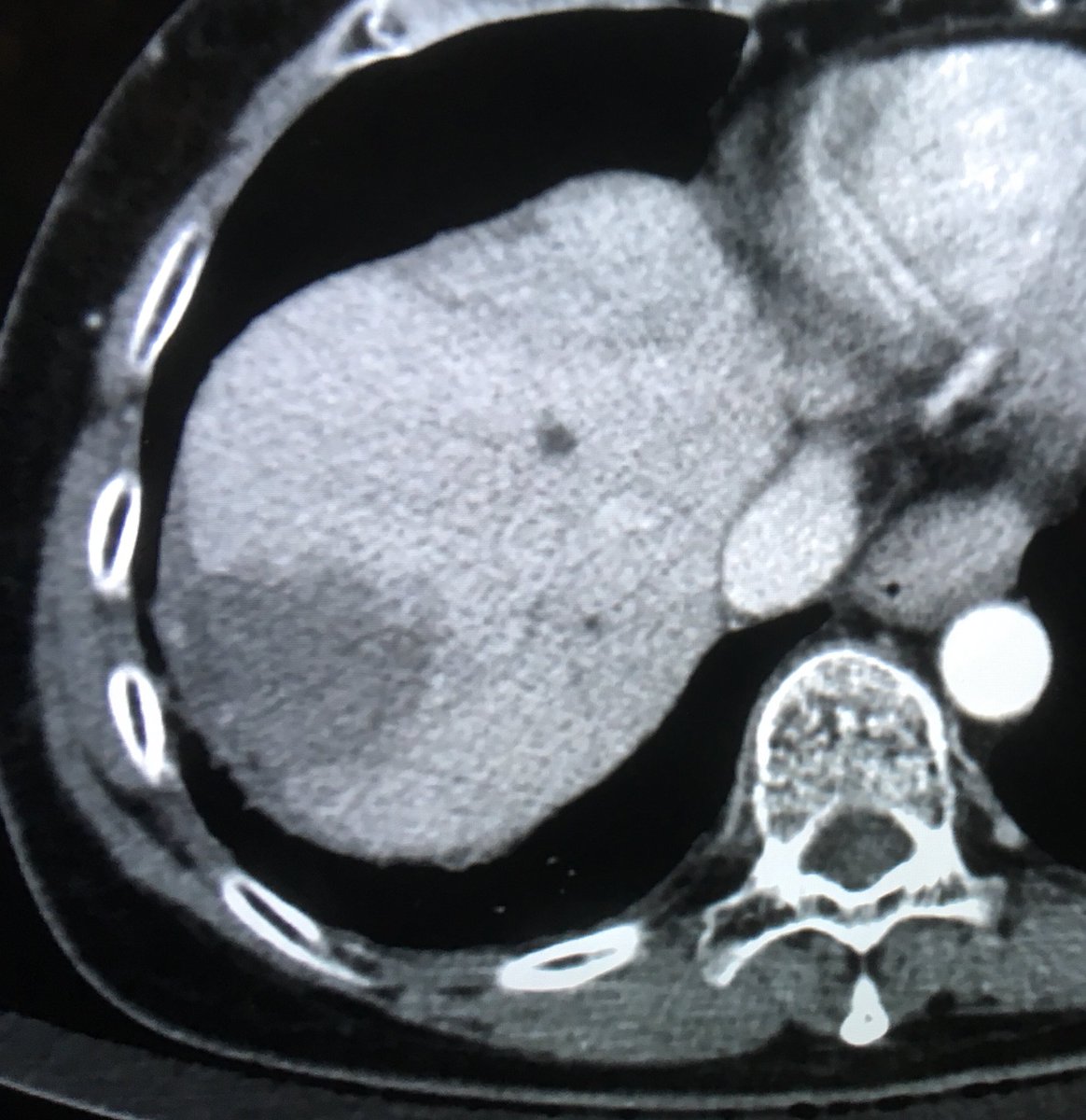 DrPatKennedy's tweet photo. Last ablation of fellowship with @MRAkid. 2 seg VII #HCC, 1 small at dome and 1 larger subcapsular. 1st stage was EtOH ablation of subcapsular component of larger lesion, then 1 week later RF ablation skewering both lesions doing 3 stacks with a 4.0 LeVeen. #IRad #ithinkwegotit https://t.co/NSsEoBvOmJ