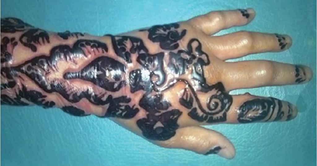 Mum Issues Warning After Seven-Year-Old Son Suffers Allergic Reaction To  Henna Tattoo - SWNS