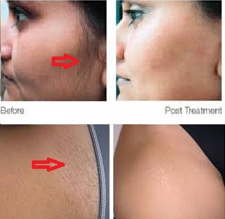 Permanent Mens Hair Removal Cream For Private Parts India Usa