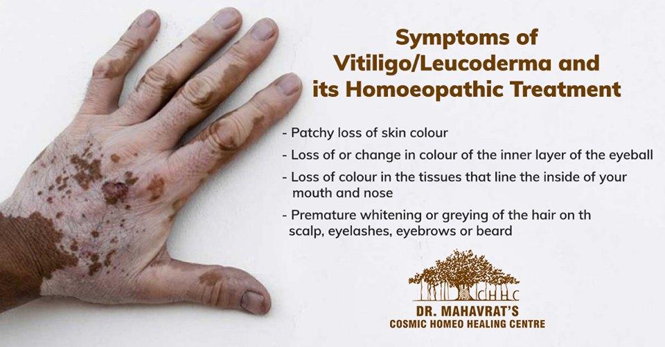 HomeopathyH's tweet image. Homoeopathy for vitiligo/leucoderma aims to control the spread of vitiligo by modulating the immune system.
If you have any of these symptoms, schedule an appointment with Dr. Mahavrat Patel and get the best vitiligo treatment.
#vitiligo #leucoderma #leucodermatreatment