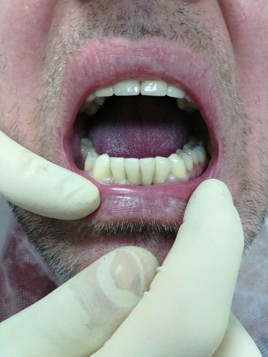 6stomatvrn's tweet image. Восстановление зубного ряда металлокерамическим протезом.
Доктор - Заиченко Константин Константиновича. #drzaichenko6stomatvrn 

🏥ул. Новгородская 121 ☎8(473)2417630 
#стоматология #6stomatvrn #Воронеж