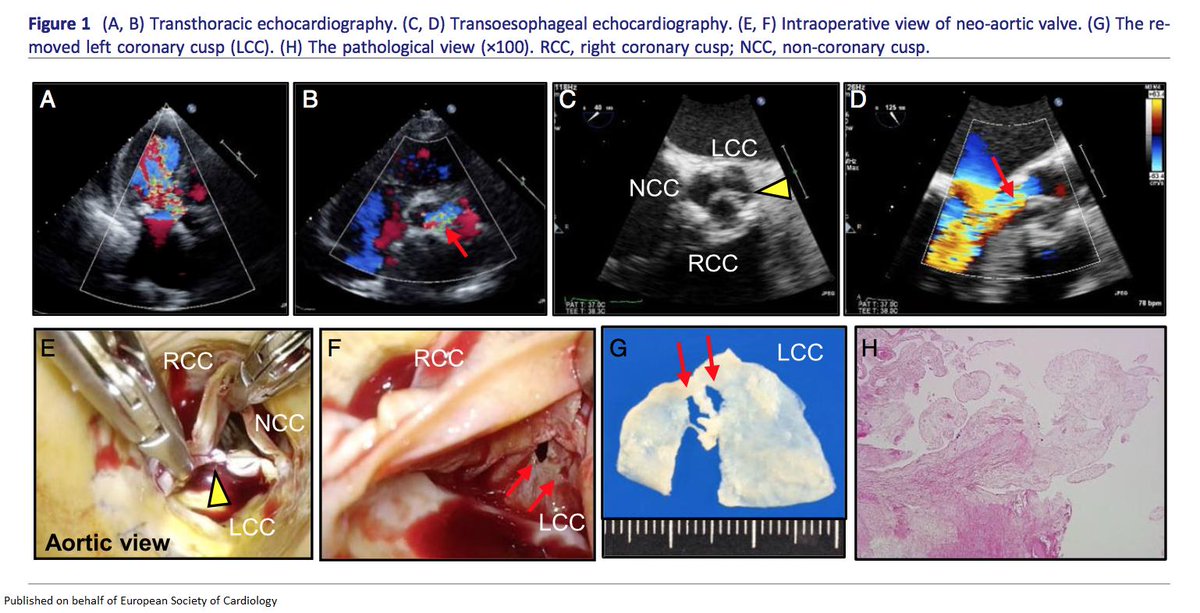 A case of aortic valve leaflet tear and perforations after neocuspidization bit.ly/2TkoE27

@escardio #ESCHeartFailure #ESCCoT #ESCardioEd #CardioTwitter #openaccess