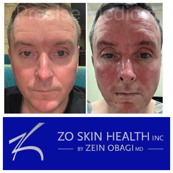 Precise_PMA's tweet image. First photo shows Gary’s skin now. 2nd photo was 4 months ago. He feels like a new man and has found his self-confidence again.  Call 01786812852 to arrange a skin consultation and find out how we can help you! #ZO skinhealth #advanced nutrition #precise_pma #skin