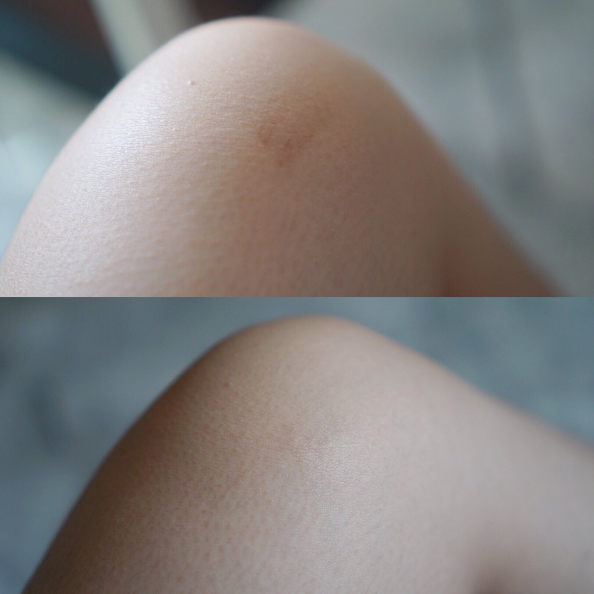 waiibearbie's tweet image. รีวิว Mederma สูตร Intense Gel รอยแผลเป็นจางลงเร็วจริง  (ของเราเป็นแผลใหม่) เนื้อเจลซึมง่าย ทาบางๆ แค่วันละครั้ง ให้ภาพมันเล่าเรื่อง &amp;lt;3