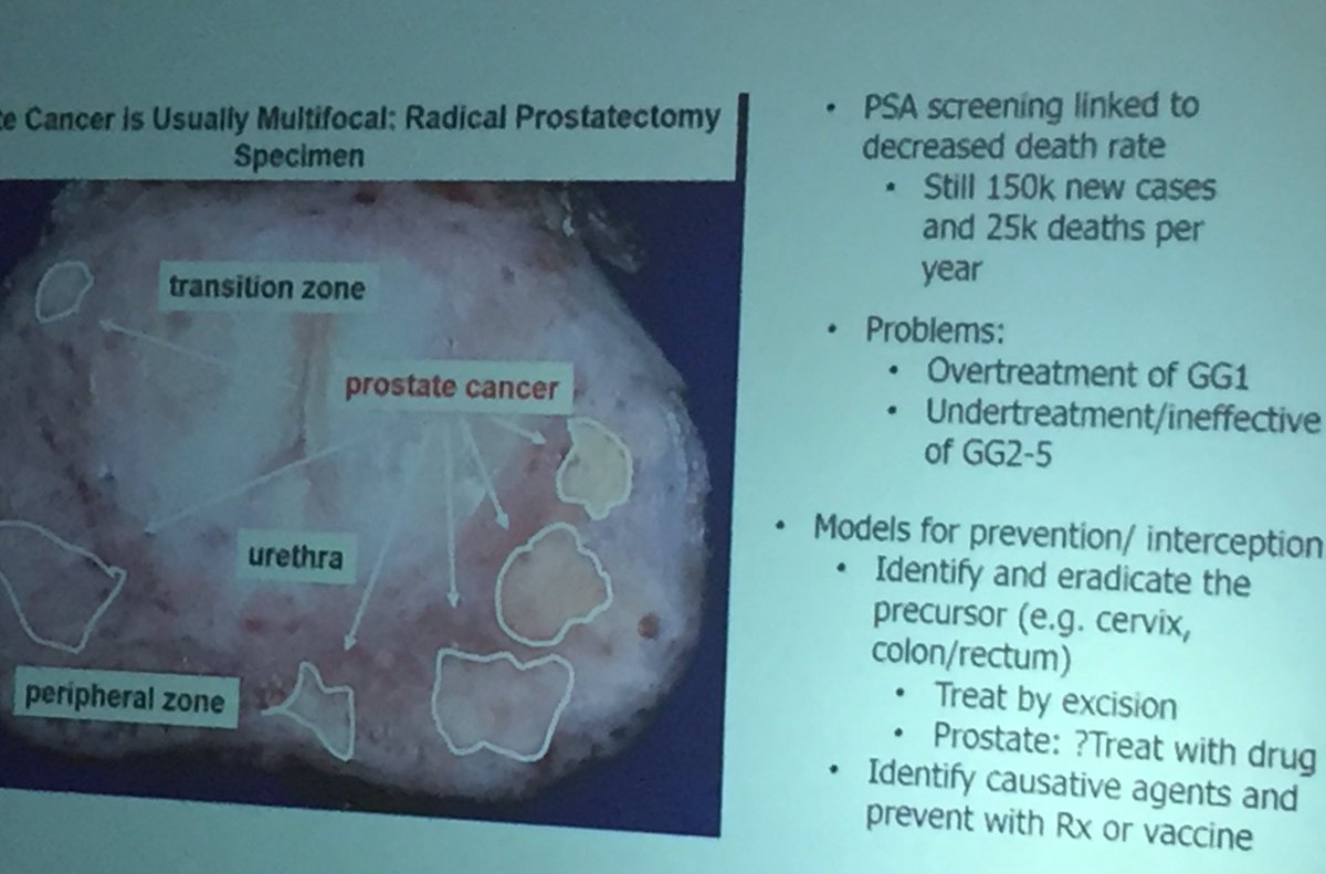 rovingatuscap's tweet photo. Dr. Angelo De Marzo @JHUPath discussing Molecular Biology of High Grade Prostatic Intraepithelial Neoplasia #PCPR19 #gupath https://t.co/5ReFHbT521
