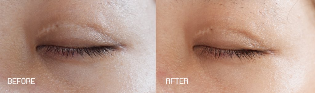 earthpynn's tweet image. มารีวิวเจลลดรอยแผลเป็นที่ใช้อยู่ก็คือ Mederma นั่นเอง 
ตัวนี้เป็นเจลมีสารสกัดจากหัวหอม ใช้ทาได้สารพัดแผลเลยทั้งเก่า-ใหม่ รอยสิว ขาลาย 
ทำหน้า ใช้แล้วมันเห็นความแตกต่างจริงๆ
คือเอิร์ธใช้เองมาหลายหลอดอยู่แล้ว แล้วเค้าก็มาให้รีวิวพอดี ตัวนี้เป็นเจลที่มีสารสกัดจากหัวหอม (1)