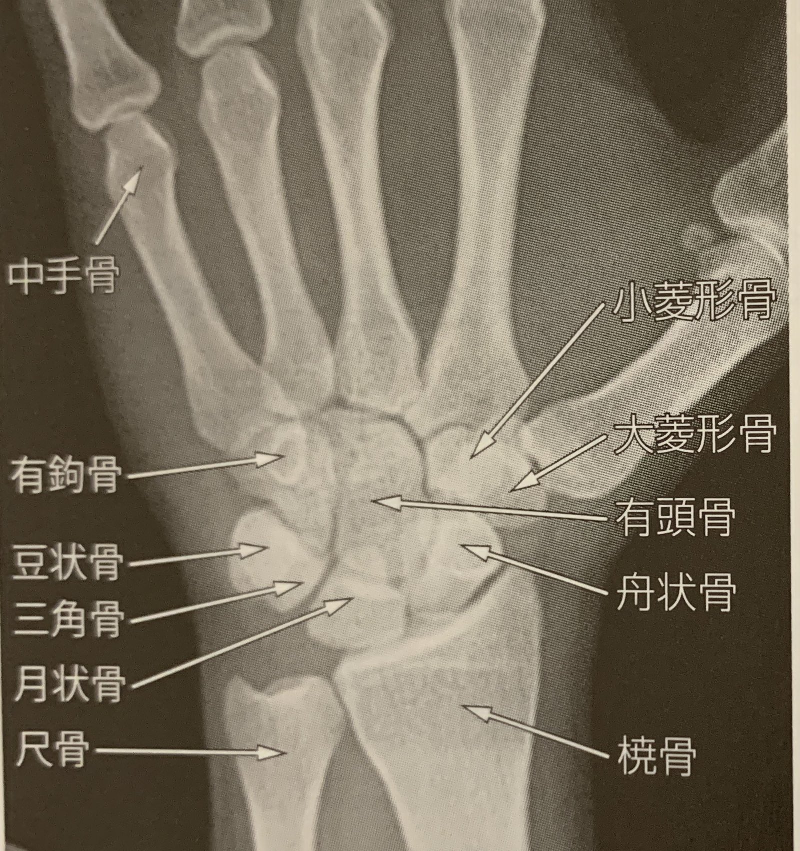 どくしょー 整形外科医 Tlを賑わせてる有鈎骨 手関節には手根骨という小さな骨が8個あります 学生のときは語呂合わせで覚えてたなぁ 父 豆状骨 さん 三角骨 の月 月状骨 収 舟状骨 は大小 大菱形骨 小菱形骨 有る 有頭骨 が 有効