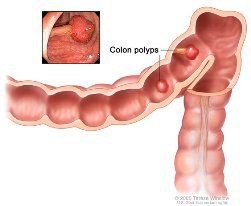 Pryority_Male's tweet photo. Precancerous polyps &amp; colorectal cancer don’t always cause symptoms, especially at first. You could have polyps or colorectal cancer &amp; not know it. 
That is why having a screening test is so important.
#BeSeenGetScreened
#KnowTheFacts
#BootyCallsMatter
#ButtsMatterToo https://t.co/nvOkTEwvEI