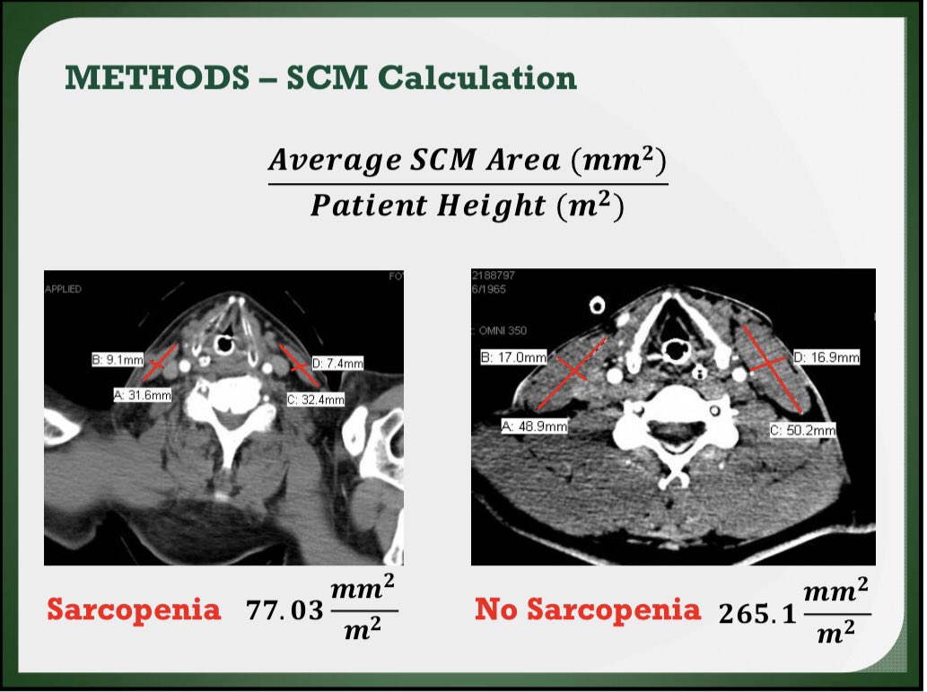 JWTraumaRama's tweet photo. 💪 Great work and excellent presentation from Michael Johns D.O. @christianacare 🔥 SCM superiority over psoas in predicting sarcopenia &amp; outcomes of trauma patients #WTA2019 #checktheneck https://t.co/ucHl5ZPLDt