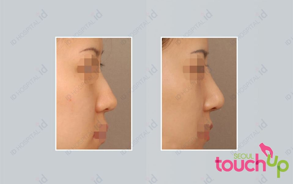 SeoulTouchUp's tweet image. Check out this before and after photos from one of our patients.

seoultouchup.com  

#seoultouchup #seoultouchup_reviews #rhinoplasty #nosejob #plasticsurgeryinkorea #plasticsurgeryresults #plasticsurgeryreviews  #koreanplasticsurgery #nosesurgery #beautifulnose