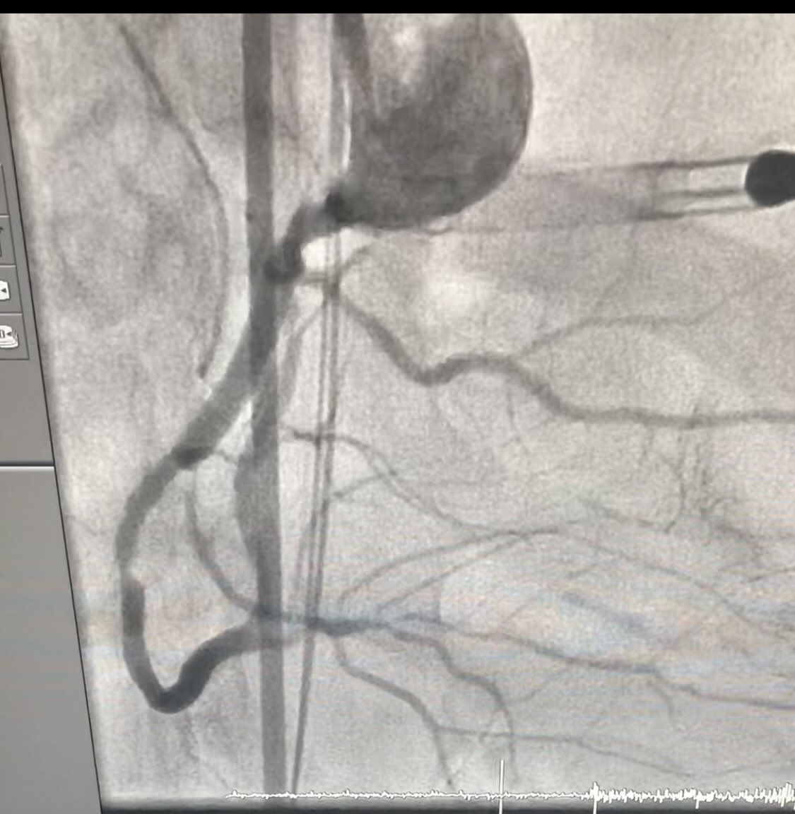 NThukralCCSA's tweet photo. Surgical turndown. EF 15%. Rotapella LAD & RCA. Cr 1.7 pre. 1.5 post. 170cc dye. @JamilMalikSTCC @SAIFSanAntonio @JGTrevino3 @DrSethdb @KeithNguyenSAIF @hinan_ahmed @RudyD_SAIF https://t.co/Y4WpJlS5q0
