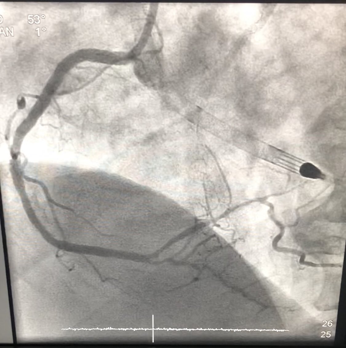 Nandish Thukral (@nthukralccsa) on Twitter photo Surgical turndown. EF 15%. Rotapella LAD & RCA. Cr 1.7 pre. 1.5 post. 170cc dye. <a href="/JamilMalikSTCC/">Jamil Malik</a> <a href="/SAIFSanAntonio/">SAIF</a> <a href="/JGTrevino3/">J.G. Trevino</a> <a href="/DrSethdb/">Seth Bilazarian, MD</a> <a href="/KeithNguyenSAIF/">Dr Keith Nguyen, MD</a> <a href="/hinan_ahmed/">Hinan Ahmed</a> @RudyD_SAIF Surgical turndown. EF 15%. Rotapella LAD & RCA. Cr 1.7 pre. 1.5 post. 170cc dye. <a href="/JamilMalikSTCC/">Jamil Malik</a> <a href="/SAIFSanAntonio/">SAIF</a> <a href="/JGTrevino3/">J.G. Trevino</a> <a href="/DrSethdb/">Seth Bilazarian, MD</a> <a href="/KeithNguyenSAIF/">Dr Keith Nguyen, MD</a> <a href="/hinan_ahmed/">Hinan Ahmed</a> @RudyD_SAIF