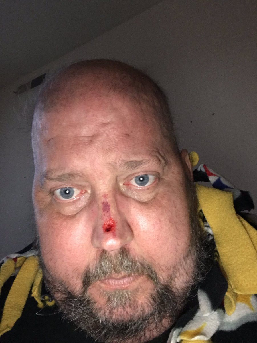BigD812's tweet photo. So I got dizzy and fell face first in my bed. Broke my glasses and peeled my nose off. #GoodTimes https://t.co/p8380wwUTP