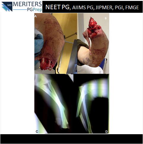pg_prep's tweet photo. What is your diagnosis?
1. Monteggia fracture-dislocation
2. Galezzi Fracture
3. Wrist amputation and Monteggia Fracture
4. Wrist dislocation
#NEET_PG #AIIMS #JIPMER #PGI #DNB #Medicine #PG_Medical_Entrance #NEETPG #MedicalEntrance #Doctor #Medical #PGPrep #ImageMCQs #Anaesthesia https://t.co/KnlXeLii1g