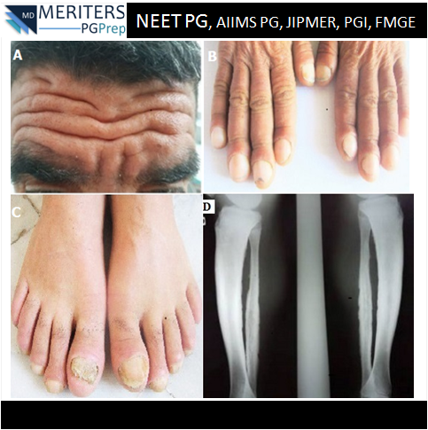 pg_prep's tweet photo. What is your diagnosis?
1. Acromegaly
2. Pachydermoperiostosis
3. Dermatomyositis
4. Annular elastopathy

#Biochemistry #ENT #Gynaecology #Medicine #Microbiology #Obstetrics #Opthalmology #Orthopaedics #paediatric #pathology #pharmacology #physiology #Psychiatry #radiology #skin https://t.co/SR80ZutYD2