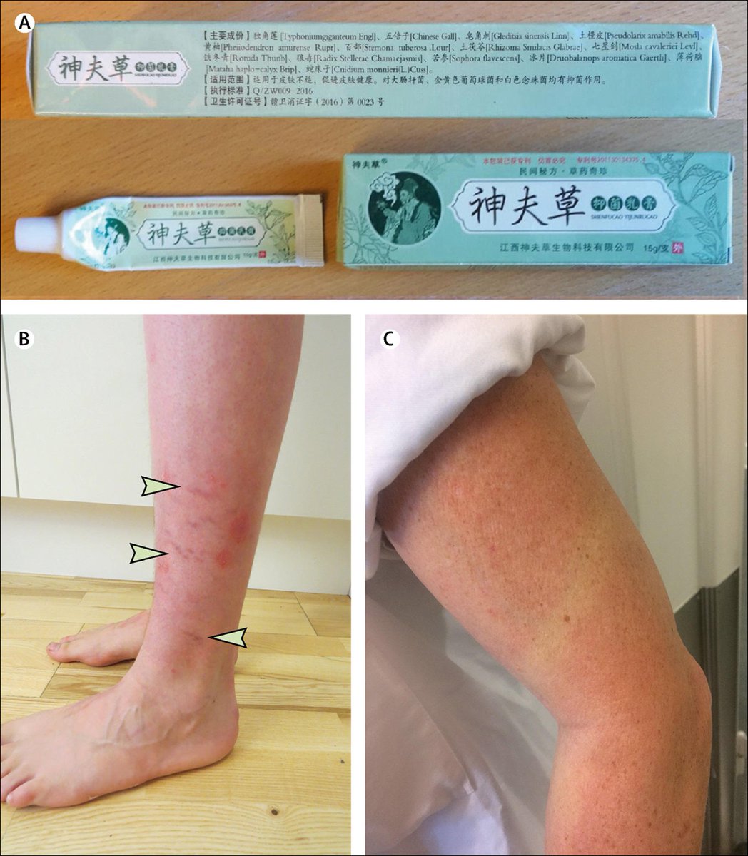 DrJoelGelfand's tweet photo. 61 new #psoriasis #PubMed hits. Highlighting this article in the #Lancet in which a 14 year old boy was using a Chinese #herbal remedy for #psoriasis which was found to contain #steroids and #antifungals resulting in #striae. This is a recurring problem. https://t.co/O35hNFLpEd