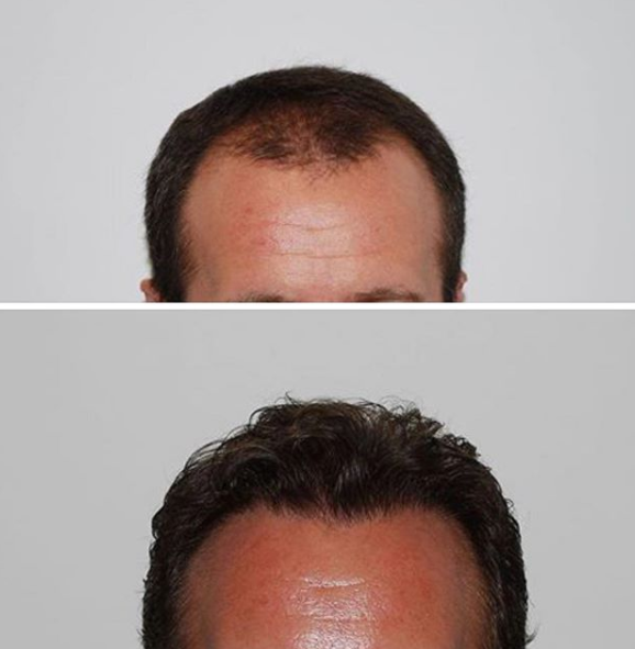 skinfinityleeds's tweet photo. Amazing results. Procedure carried out by Dr Donato Zizi.

https://t.co/qgJVc4pMqa https://t.co/3V3ObM8iyD