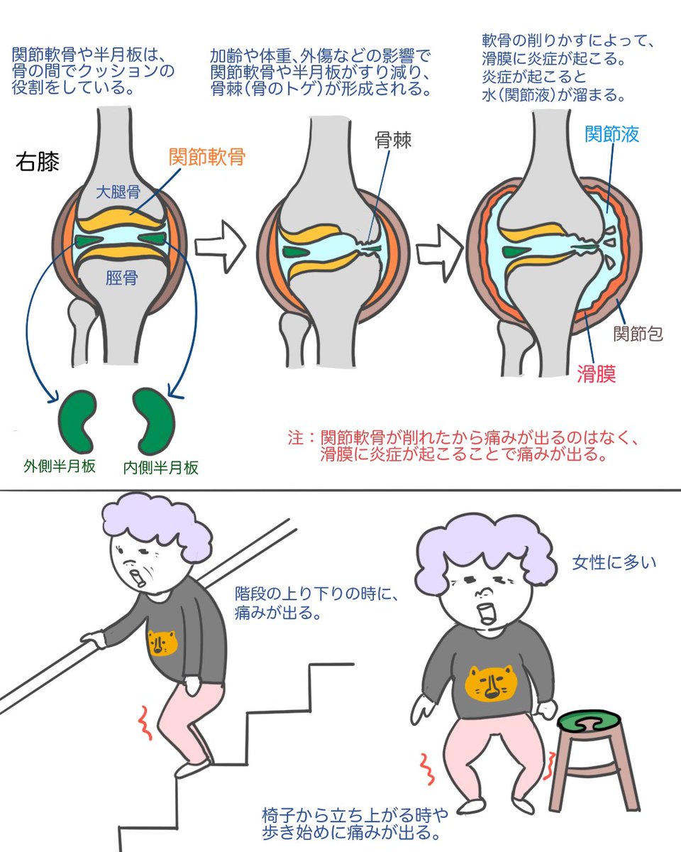 ゴロ 解剖生理イラスト 在 Twitter 上 1分で分かる 変形性膝関節症 この疾患に悩まされている患者さんは多いから 頭の片隅に入れておいた方が良いっす T Co Pdpfpmnjpp Twitter