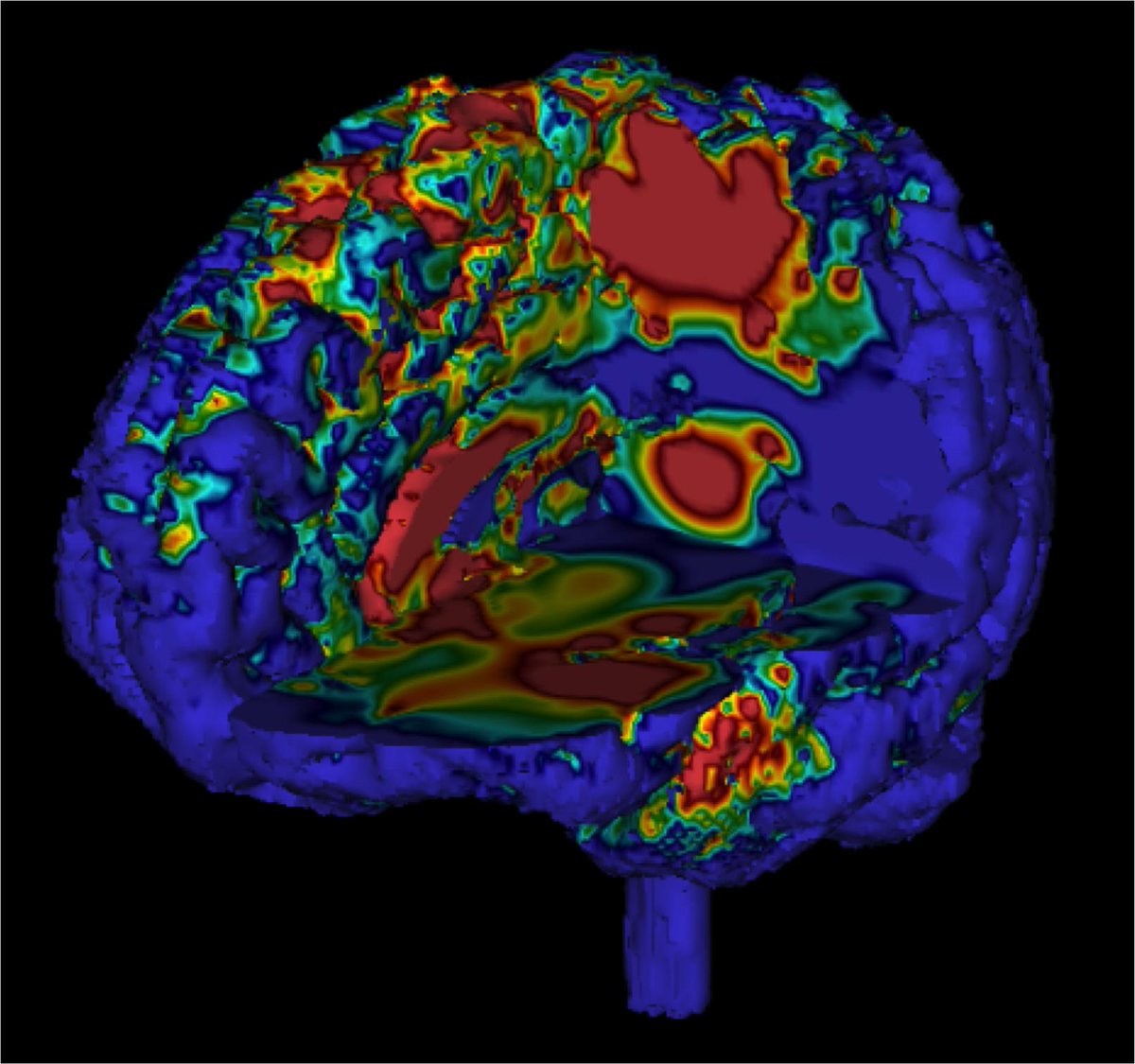 Mazdak Ghajari (@ghajarimazdak) on Twitter photo Our latest paper <a href="/SciReports/">Scientific Reports</a> : rdcu.be/bpvD1 (open access). Here we show the promise of viscoelastic materials in mitigating #TBI, #helmet. Thanks to @RheonLabs, <a href="/AGVHelmets/">AGV Helmets</a> and @SBRI_InnovateUK for supporting the work. <a href="/Neurosharp/">@Neurosharp</a> <a href="/ImperialDyson/">Dyson School of Design Engineering</a> Our latest paper <a href="/SciReports/">Scientific Reports</a> : rdcu.be/bpvD1 (open access). Here we show the promise of viscoelastic materials in mitigating #TBI, #helmet. Thanks to @RheonLabs, <a href="/AGVHelmets/">AGV Helmets</a> and @SBRI_InnovateUK for supporting the work. <a href="/Neurosharp/">@Neurosharp</a> <a href="/ImperialDyson/">Dyson School of Design Engineering</a>