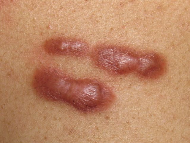 Do you have a #keloid scar? Please fill in our short survey. surveymonkey.co.uk/r/keloidsbsf 

#keloids
#keloidscar
#CharityTuesday