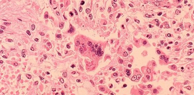 Case of measles confirmed in Scarborough 
durhamradionews.com/archives/117461