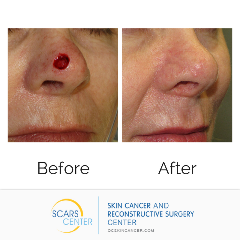 SCARSCenter's tweet image. Our clinic combines #skincancer treatment with facial rejuvenation. Like this patient here, you won't even notice the scar even after treatment. With some light facial #rejuvenation, the scar will be a thing of the past. Call today for a consultation: (949) 719-1800