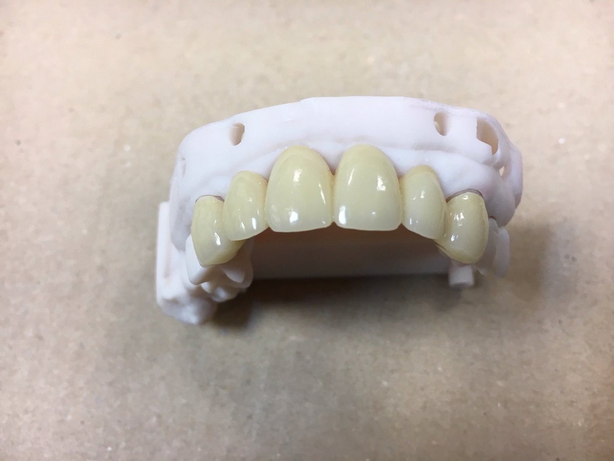 QualityCeramics's tweet photo. Six Unit Zirconia Bridge from Trios Intra-Oral Scan, using carbon printed 3-Shape model, great to work on, with a nice aesthetic result. ⁦@QualityCeramics⁩ https://t.co/LpnHUXzdVn
