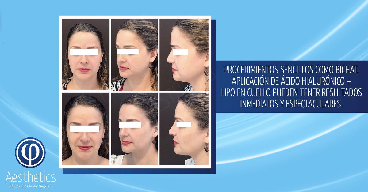 gjcplastico's tweet photo. Queremos compartirte este caso de #bichat, #lipo en el cuello y ácido hialurónico en nariz. Los tres son procedimientos muy sencillos, de recuperación prácticamente inmediata y con resultados sutiles y sorprendentes.
¡Anímate! Agenda al 477 7132835 📲 #PhiAestheticsMX https://t.co/U8auzGMtuF
