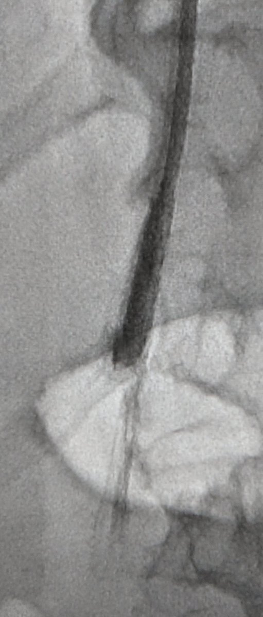 LessneVIR's tweet photo. Great day w my colleague #DrRonSing, surgeon & fellow #FilterNerd. We set up #FilterOut day today! Filters w 6 mos-15 yr dwell time; fractured TrapEase to Recovery; used laser, forceps & even #oldschool recovery cone. All out safely for good cause #IRad @CLTRadiology https://t.co/5Lbri29AFO