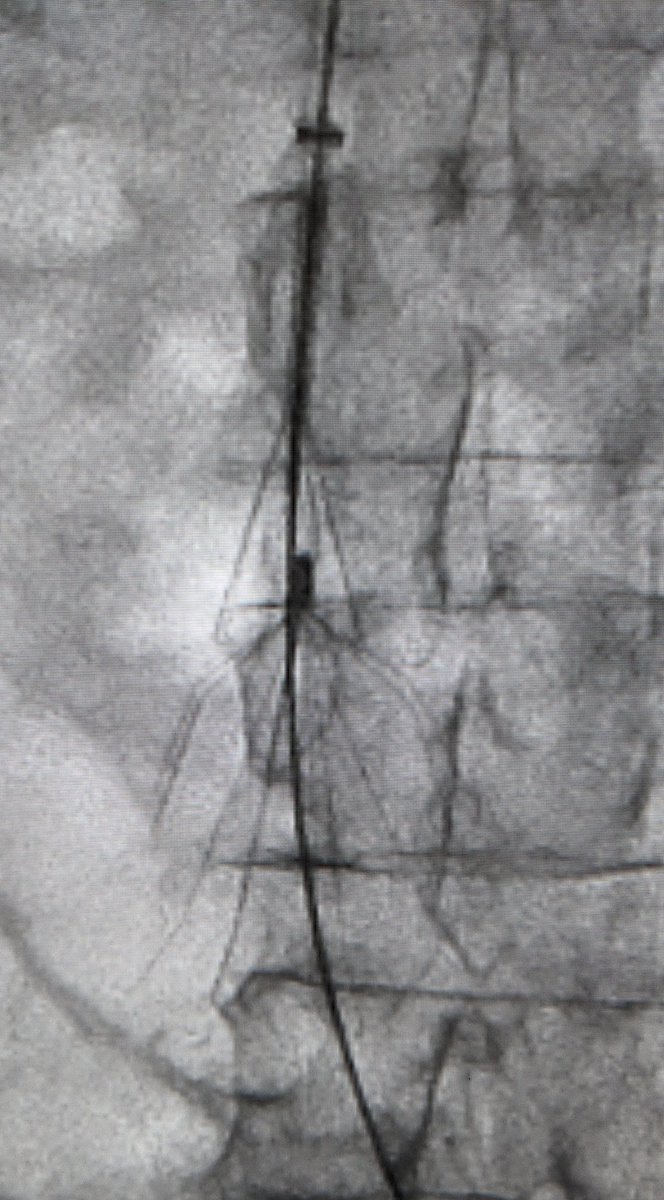 LessneVIR's tweet photo. Great day w my colleague #DrRonSing, surgeon & fellow #FilterNerd. We set up #FilterOut day today! Filters w 6 mos-15 yr dwell time; fractured TrapEase to Recovery; used laser, forceps & even #oldschool recovery cone. All out safely for good cause #IRad @CLTRadiology https://t.co/5Lbri29AFO