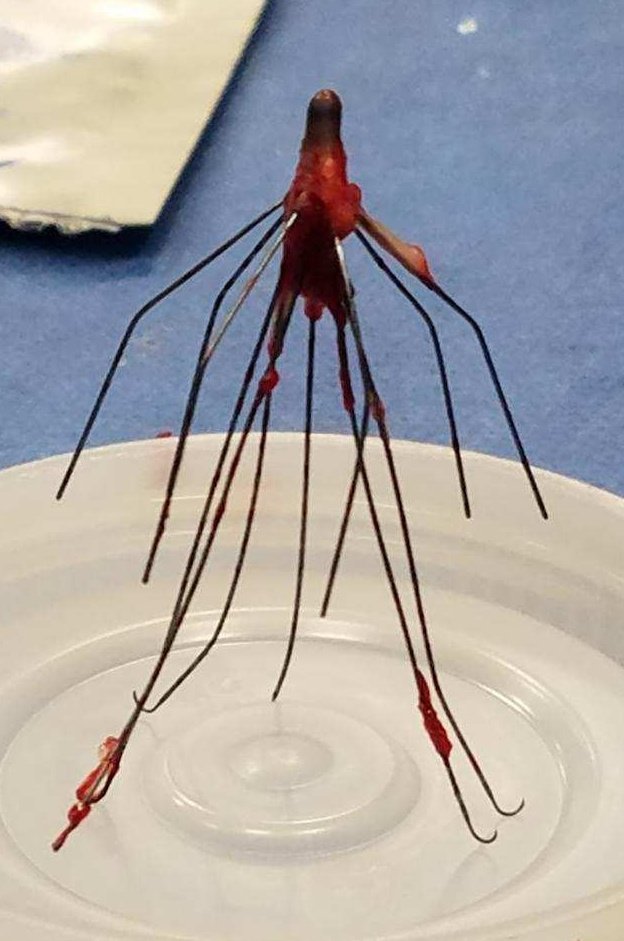 LessneVIR's tweet photo. Great day w my colleague #DrRonSing, surgeon & fellow #FilterNerd. We set up #FilterOut day today! Filters w 6 mos-15 yr dwell time; fractured TrapEase to Recovery; used laser, forceps & even #oldschool recovery cone. All out safely for good cause #IRad @CLTRadiology https://t.co/5Lbri29AFO