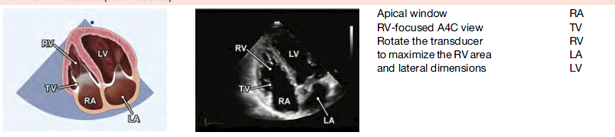 carolKCM's tweet photo. @kgzimmerman RV focused view, obtained from the apical window, from the A4C view rotate the transducer to maximize the RV area and lateral dimensions https://t.co/k9vT1AJMCz