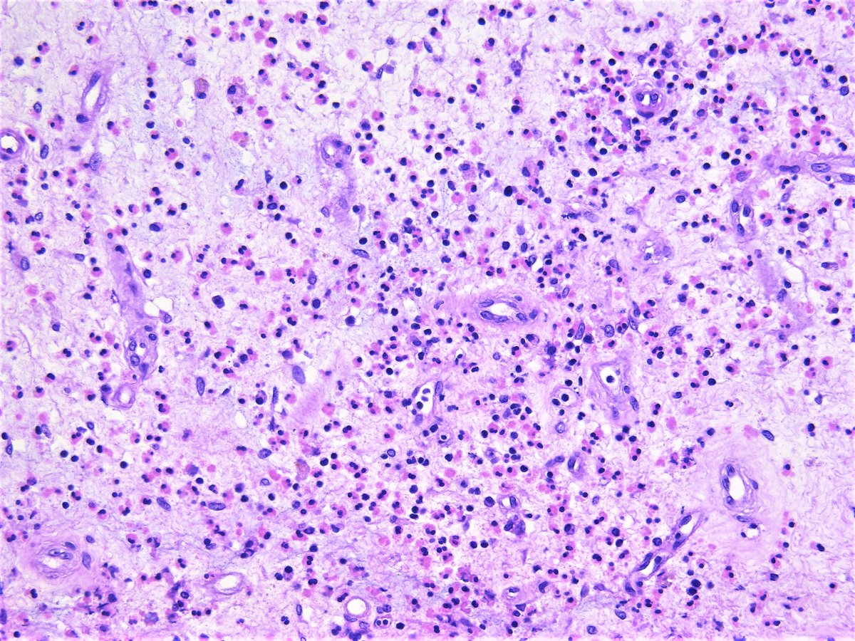 Patholwalker's tweet image. Eosinophilic sinusitis. Nasal cavity (polyp), excisional biopsy. #pathology #ENTpath