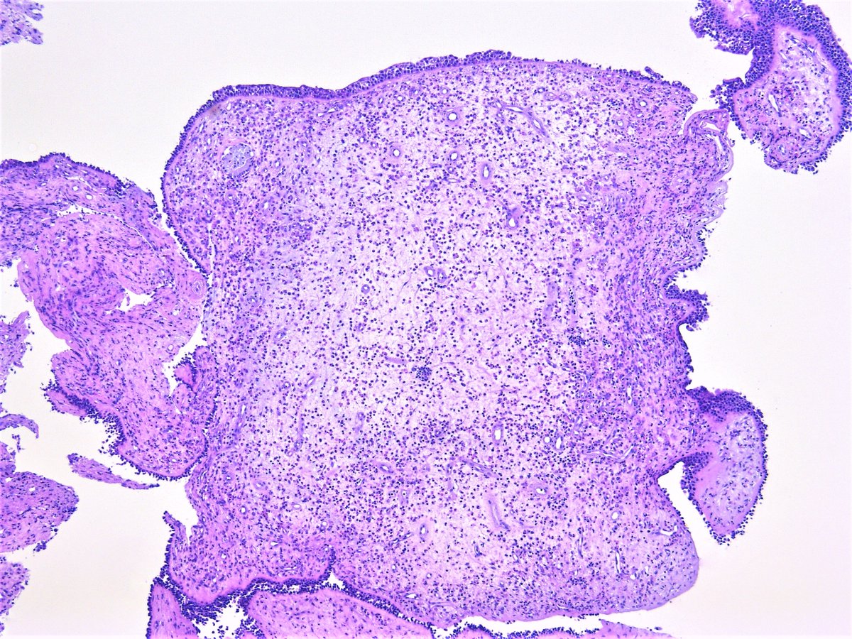 Patholwalker's tweet image. Eosinophilic sinusitis. Nasal cavity (polyp), excisional biopsy. #pathology #ENTpath