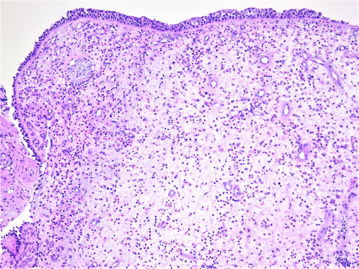Patholwalker's tweet image. Eosinophilic sinusitis. Nasal cavity (polyp), excisional biopsy. #pathology #ENTpath
