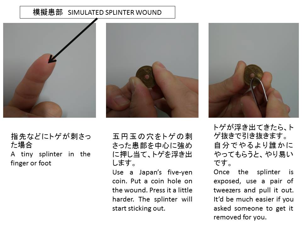 警視庁警備部災害対策課 トゲが刺さったときには５円玉が便利です に反響を頂きました 外国の方々にもお伝えしたく英語版を作ってみました We Tweeted About A Remedy Entitled A Japan S Five Yen Coin Will Work Well To Pull A Splinter Out And Had