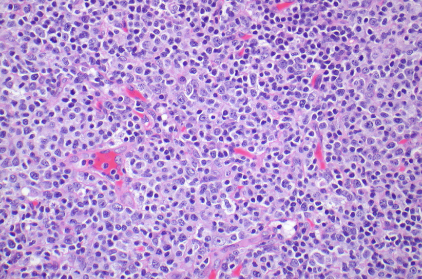 brent_tan's tweet photo. Autoimmune lymphoproliferative syndrome (ALPS)
▶Follicular hyperplasia ± PTGC ± regressed follicles
▶Prominent paracortical hyperplasia by polyclonal αβ T-cells: CD3+CD4-CD8-CD45RA+CD45RO- with high proliferation and CD57+, TIA+, perforin+ 
▶Polyclonal plasmacytosis https://t.co/Exg4DjP3k9